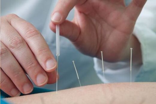 Acupuncture - a method of treating pain in the lower back caused by osteochondrosis