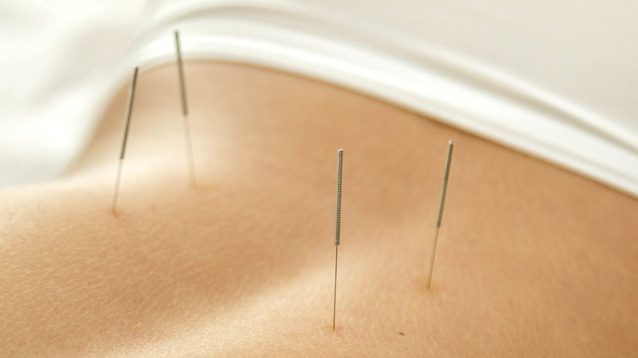 Acupuncture will help get rid of lower back pain